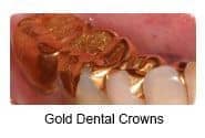 Gold Dental Restorations